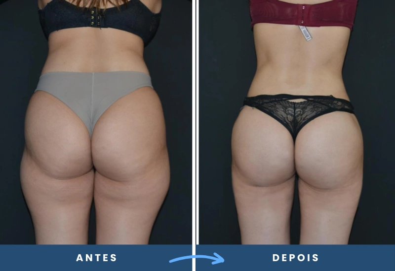 Resultado da lipoaspiração de alta definição em mulher, com contornos mais definidos na região dos glúteos e abdômen, realizado em São Bernardo do Campo. Resultado da lipoaspiração de alta definição em mulher, com contornos mais definidos na região dos glúteos e abdômen, realizado em São Bernardo do Campo.