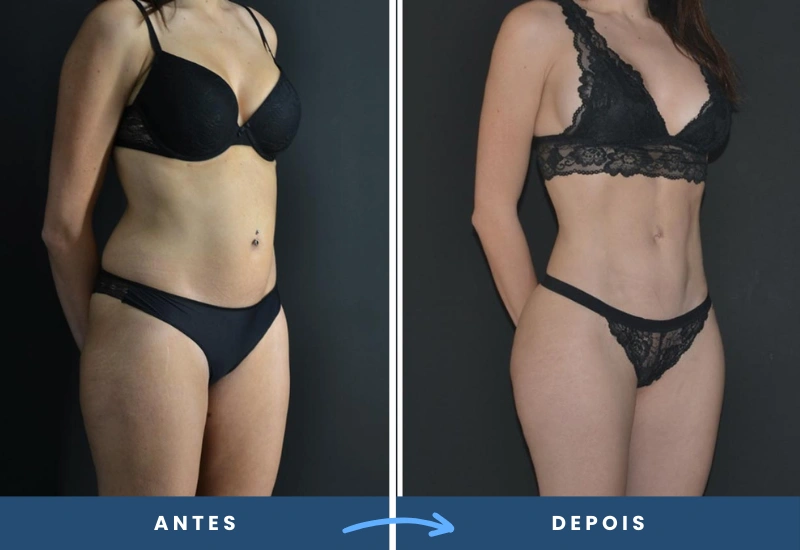 Antes e depois da lipoaspiração de alta definição em mulher, mostrando cintura Antes e depois da lipoaspiração de alta definição em mulher, mostrando cintura