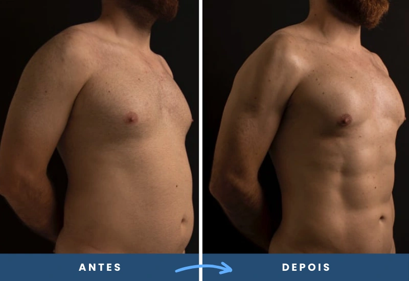 182 Antes e depois da lipoaspiração de alta definição em homem, com destaque para a musculatura abdominal, realizado em São Bernardo do Campo.