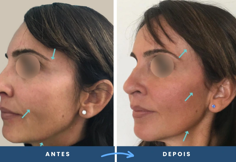Antes e depois de lifting temporal não cirúrgico, com elevação das sobrancelhas e contorno facial mais firme, realizado em São Bernardo do Campo. Antes e depois de lifting temporal não cirúrgico, com elevação das sobrancelhas e contorno facial mais firme, realizado em São Bernardo do Campo.