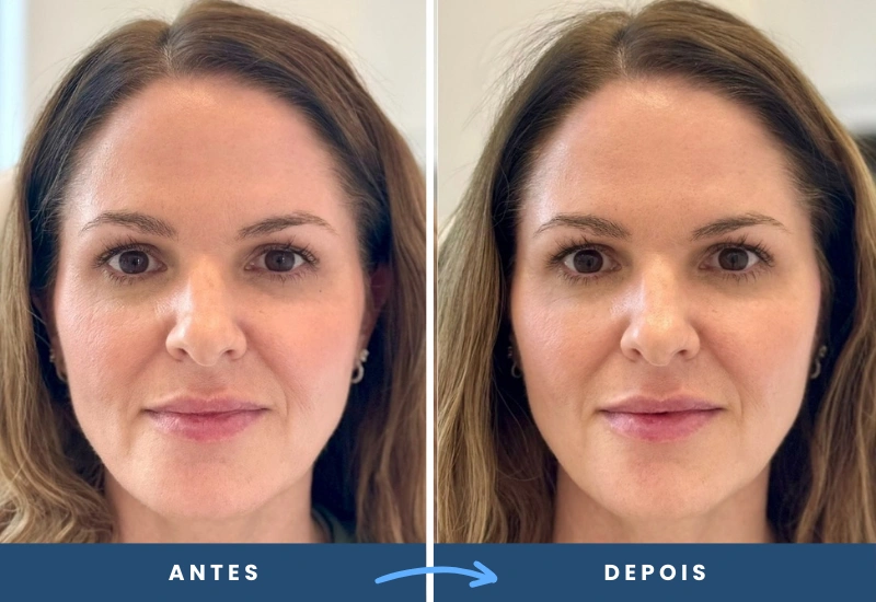 Comparação de antes e depois do lifting temporal não cirúrgico, destacando um olhar mais elevado e contornos definidos.