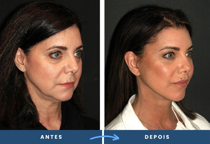Antes e depois de lifting temporal não cirúrgico, evidenciando contornos faciais firmes e rejuvenescidos. Antes e depois de lifting temporal não cirúrgico, evidenciando contornos faciais firmes e rejuvenescidos.