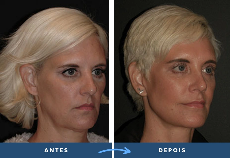 Resultado de lifting temporal não cirúrgico em mulher, suavizando a expressão e rejuvenescendo o olhar. Resultado de lifting temporal não cirúrgico em mulher, suavizando a expressão e rejuvenescendo o olhar.