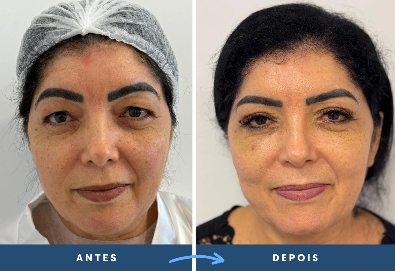 Antes e depois de blefaroplastia em mulher, mostrando rejuvenescimento visível nas pálpebras. Cirurgia realizada em são bernardo do campo, pelo cirurgião plástico dr porfirio martinez