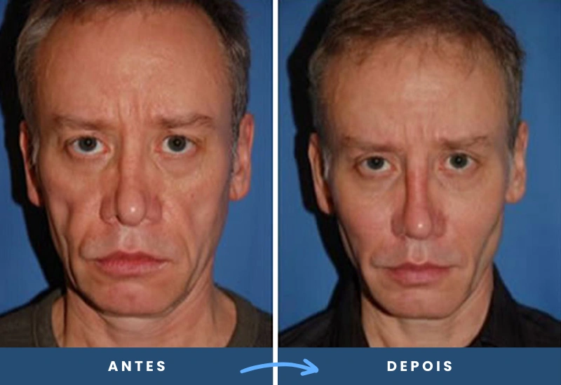 Resultado de implantes faciais em homem, com contornos mais definidos e simétricos, realizado em São Bernardo do Campo. Resultado de implantes faciais em homem, com contornos mais definidos e simétricos, realizado em São Bernardo do Campo.