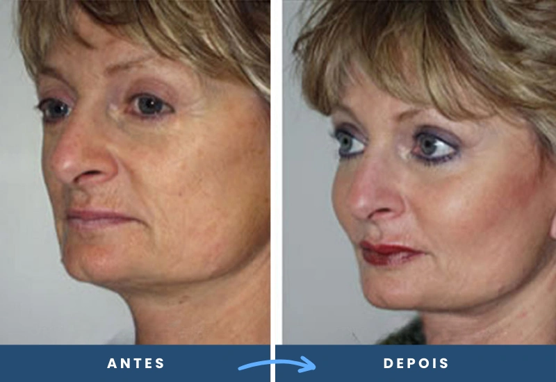 Comparação de antes e depois de implantes faciais em mulher, com traços mais definidos e volumosos, realizado em São Bernardo do Campo. Comparação de antes e depois de implantes faciais em mulher, com traços mais definidos e volumosos, realizado em São Bernardo do Campo.