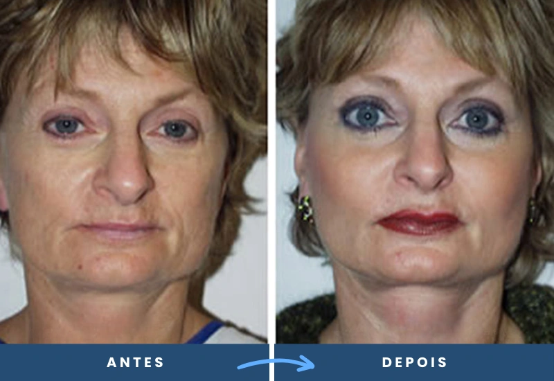 Antes e depois de implantes faciais em mulher, mostrando contornos volumosos e naturais, realizado por cirurgião plástico em São Bernardo do Campo. Antes e depois de implantes faciais em mulher, mostrando contornos volumosos e naturais, realizado por cirurgião plástico em São Bernardo do Campo.