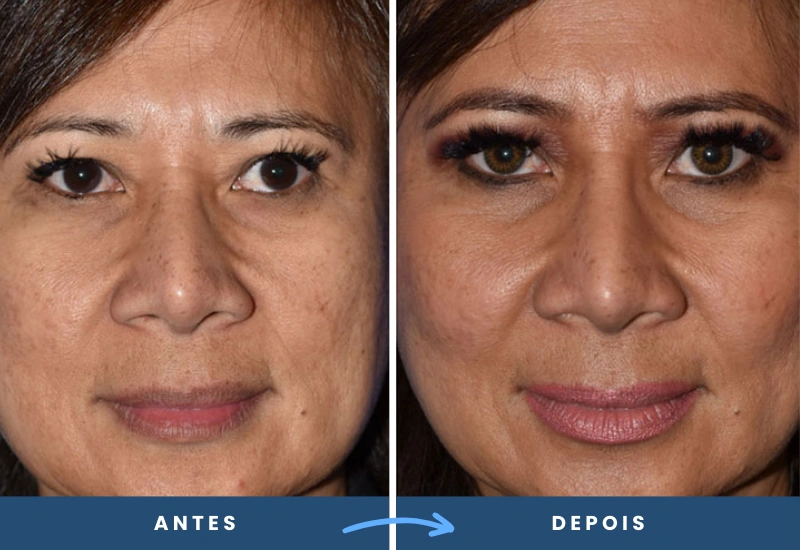 Antes e depois de implantes faciais em mulher, com aparência mais jovem e volumosa, realizado em São Bernardo do Campo. Antes e depois de implantes faciais em mulher, com aparência mais jovem e volumosa, realizado em São Bernardo do Campo.