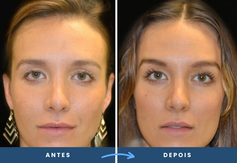 Antes e depois de lifting de sobrancelha em mulher, mostrando traços mais equilibrados e suaves, realizado por especialista em São Bernardo do Campo. Antes e depois de lifting de sobrancelha em mulher, mostrando traços mais equilibrados e suaves, realizado por especialista em São Bernardo do Campo.