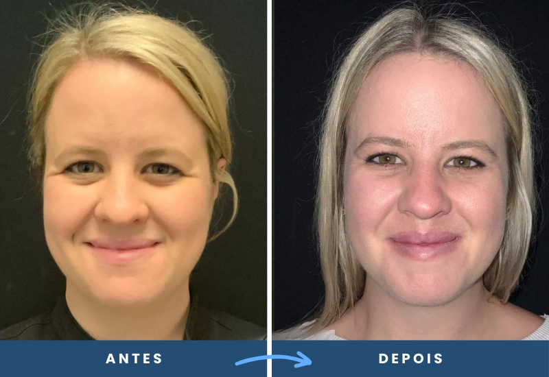 Resultado de lifting de sobrancelha em mulher, com aparência rejuvenescida e harmonia facial, realizado em São Bernardo do Campo. Resultado de lifting de sobrancelha em mulher, com aparência rejuvenescida e harmonia facial, realizado em São Bernardo do Campo.