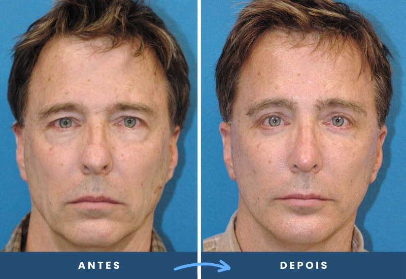 Antes e depois de lifting frontal em homem, com traços mais jovens e suavizados, realizado em São Bernardo do Campo. Antes e depois de lifting frontal em homem, com traços mais jovens e suavizados, realizado em São Bernardo do Campo.