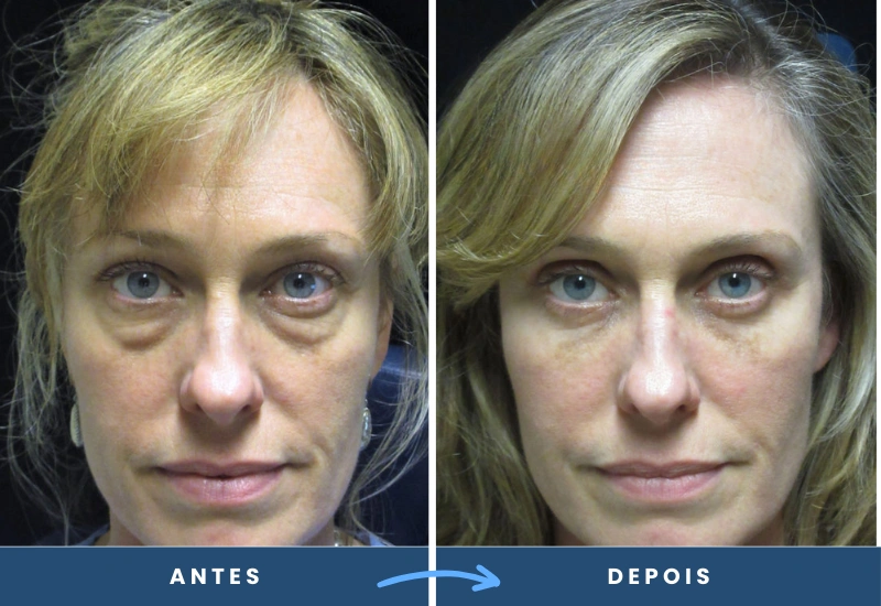 Antes e depois de blefaroplastia em mulher, evidenciando pálpebras livres de bolsas e rugas. Antes e depois de blefaroplastia em mulher, evidenciando pálpebras livres de bolsas e rugas.