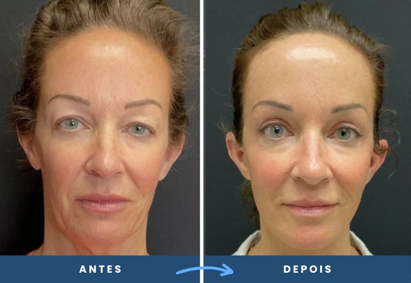 Antes e depois de lifting frontal em mulher, destacando uma testa mais lisa e expressão equilibrada, realizado em São Bernardo do Campo.