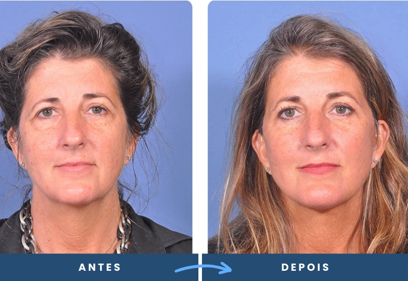 Antes e depois de lifting frontal em mulher, com testa lisa e traços rejuvenescidos, realizado em São Bernardo do Campo. Antes e depois de lifting frontal em mulher, com testa lisa e traços rejuvenescidos, realizado em São Bernardo do Campo.
