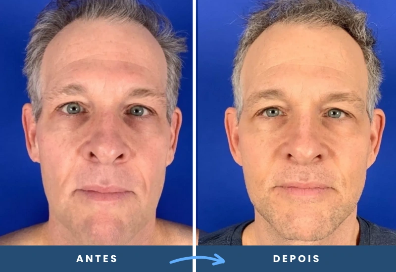 Antes e depois de lifting frontal em homem, evidenciando rosto rejuvenescido, realizado em São Bernardo do Campo.