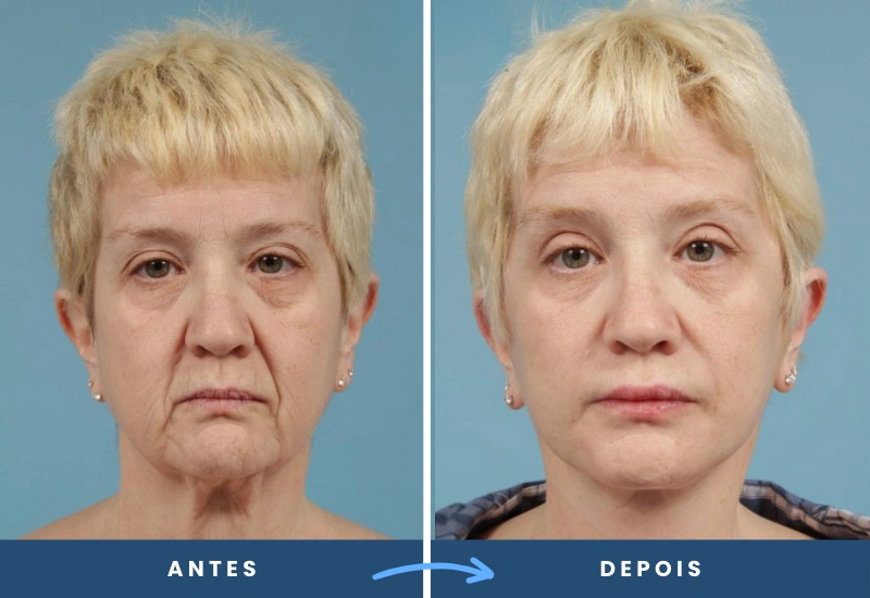 Antes e depois de lifting facial em mulher, com traços mais jovens e contornos definidos, cirurgia plástica em São Bernardo do Campo.