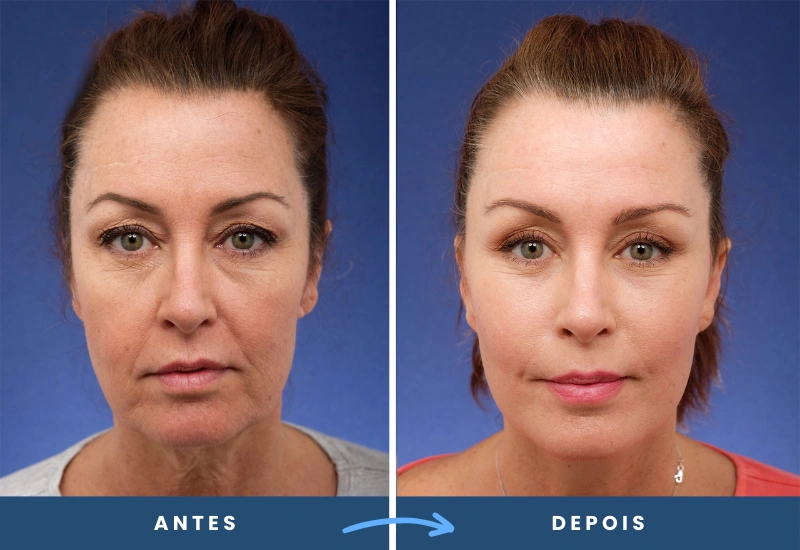Antes e depois de ritidoplastia em mulher, destacando contornos faciais mais firmes e proporcionais, realizado em São Bernardo do Campo. Antes e depois de ritidoplastia em mulher, destacando contornos faciais mais firmes e proporcionais, realizado em São Bernardo do Campo.