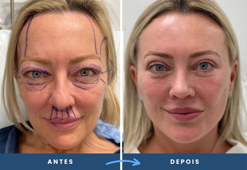 Antes e depois de lifting facial em mulher, evidenciando traços mais suaves e harmoniosos, realizado por cirurgião plástico em São Bernardo do Campo. Antes e depois de lifting facial em mulher, evidenciando traços mais suaves e harmoniosos, realizado por cirurgião plástico em São Bernardo do Campo.