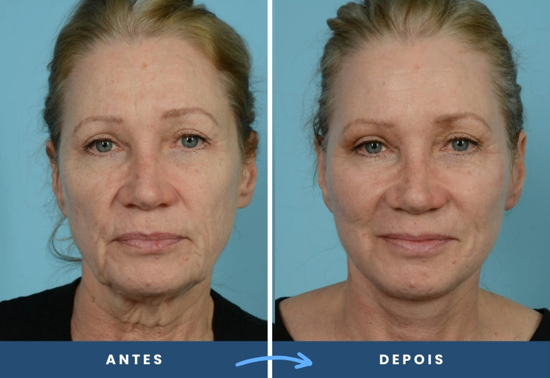 Antes e depois de ritidoplastia em mulher, com traços faciais mais definidos e aparência jovem, realizado em São Bernardo do Campo. Antes e depois de ritidoplastia em mulher, com traços faciais mais definidos e aparência jovem, realizado em São Bernardo do Campo.