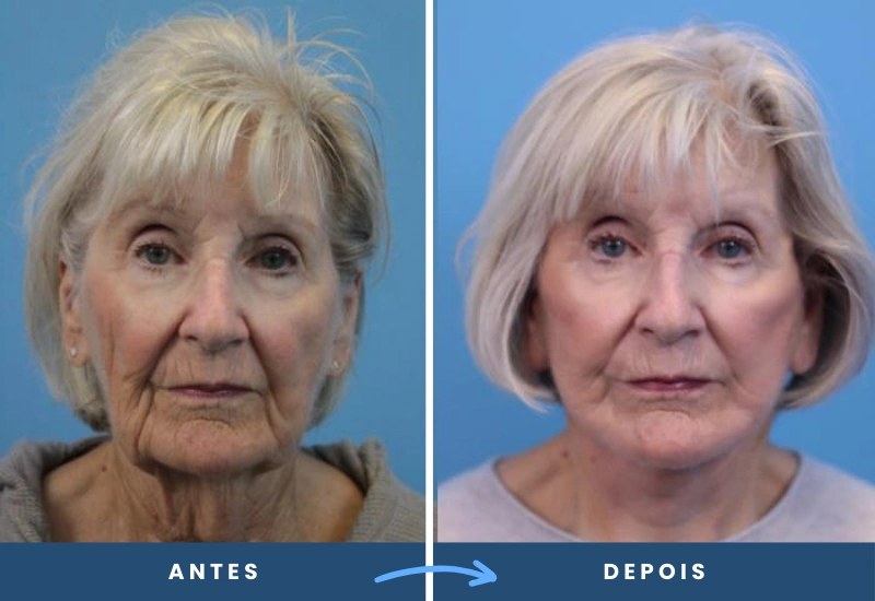 Antes e depois de ritidoplastia em mulher, mostrando contornos mais firmes e proporcionais, realizado em São Bernardo do Campo. Antes e depois de ritidoplastia em mulher, mostrando contornos mais firmes e proporcionais, realizado em São Bernardo do Campo.