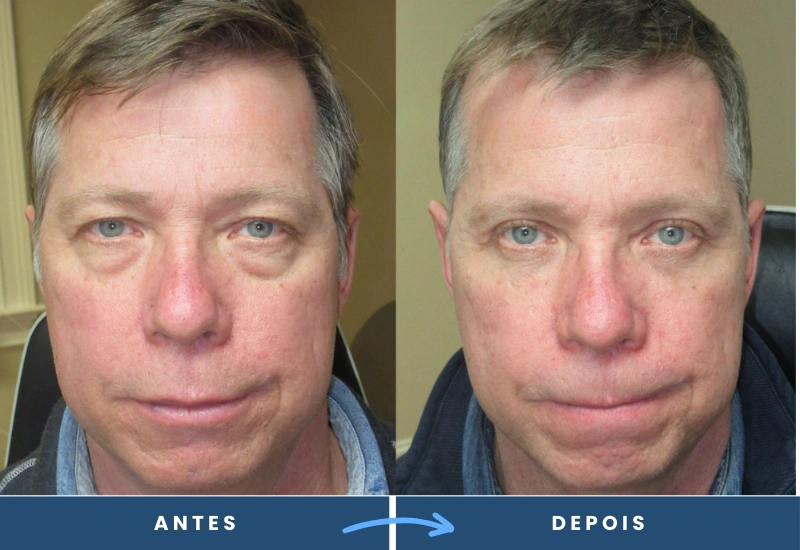 Antes e depois de blefaroplastia em homem, com olhar mais jovem e firme. Antes e depois de blefaroplastia em homem, com olhar mais jovem e firme. Cirurgia realizada em são bernardo do campo, pelo cirurgião plástico dr porfirio martinez