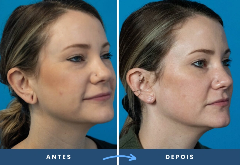 Antes e depois de cirurgia de lobuloplastia em mulher, mostrando lóbulos da orelha restaurados e simétricos, realizado em São Bernardo do Campo.