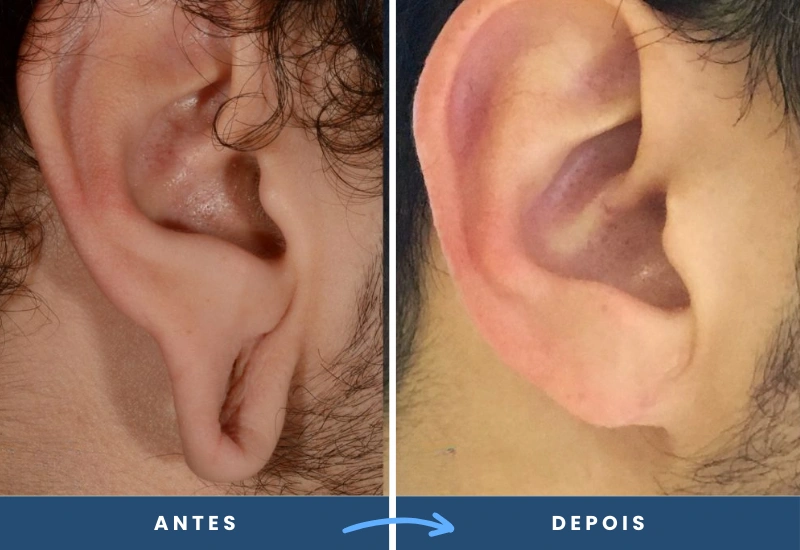 Antes e depois de lobuloplastia em homem, evidenciando lóbulos reconstruídos e proporcionais, realizado em São Bernardo do Campo.