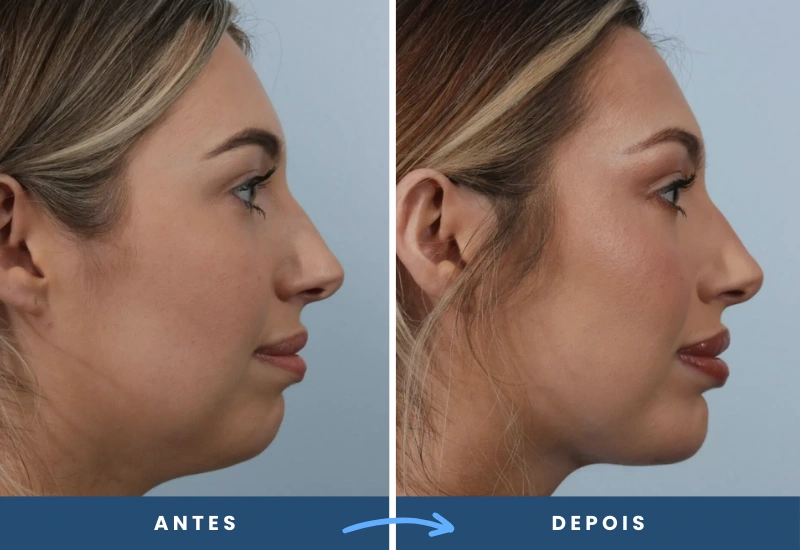 Antes e depois de mentoplastia em mulher, mostrando um queixo mais definido e harmonioso, realizado em São Bernardo do Campo. Antes e depois de mentoplastia em mulher, mostrando um queixo mais definido e harmonioso, realizado em São Bernardo do Campo.