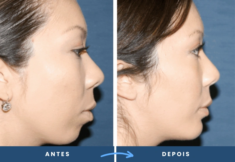 Antes e depois de mentoplastia em mulher, destacando um queixo mais proporcional e equilibrado, realizado em São Bernardo do Campo. Antes e depois de mentoplastia em mulher, destacando um queixo mais proporcional e equilibrado, realizado em São Bernardo do Campo.