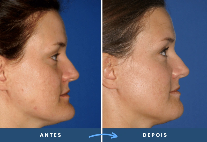 Antes e depois de mentoplastia em mulher, mostrando perfil mais proporcional e harmônico, realizado em São Bernardo do Campo. Antes e depois de mentoplastia em mulher, mostrando perfil mais proporcional e harmônico, realizado em São Bernardo do Campo.