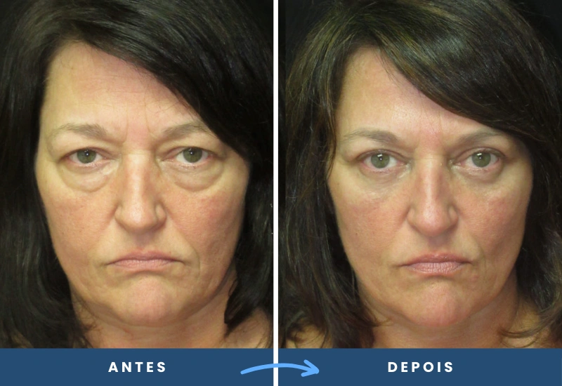Antes e depois de blefaroplastia em mulher, mostrando pálpebras mais firmes e simétricas.