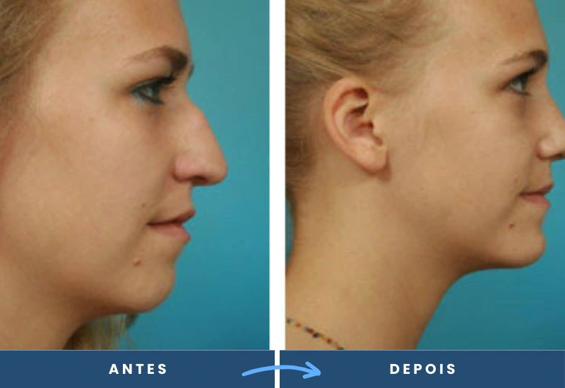 Antes e depois de mentoplastia em mulher, com projeção do queixo ajustada e traços equilibrados, realizado por cirurgião plástico em São Bernardo do Campo. Antes e depois de mentoplastia em mulher, com projeção do queixo ajustada e traços equilibrados, realizado por cirurgião plástico em São Bernardo do Campo.