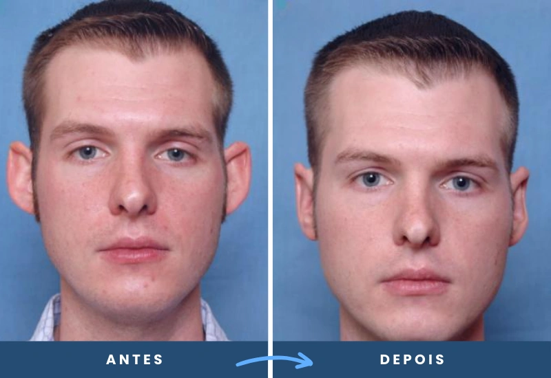 Antes e depois de otoplastia em homem, mostrando orelhas proporcionais e harmônicas, realizado em São Bernardo do Campo. Antes e depois de otoplastia em homem, mostrando orelhas proporcionais e harmônicas, realizado em São Bernardo do Campo.