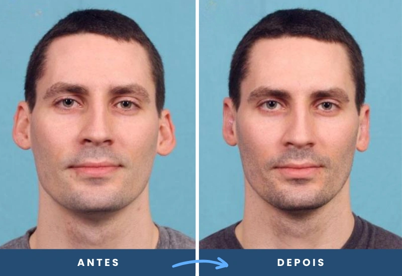 Antes e depois de plástica das orelhas em homem, destacando proporção e alinhamento, realizado em São Bernardo do Campo. Antes e depois de plástica das orelhas em homem, destacando proporção e alinhamento, realizado em São Bernardo do Campo.