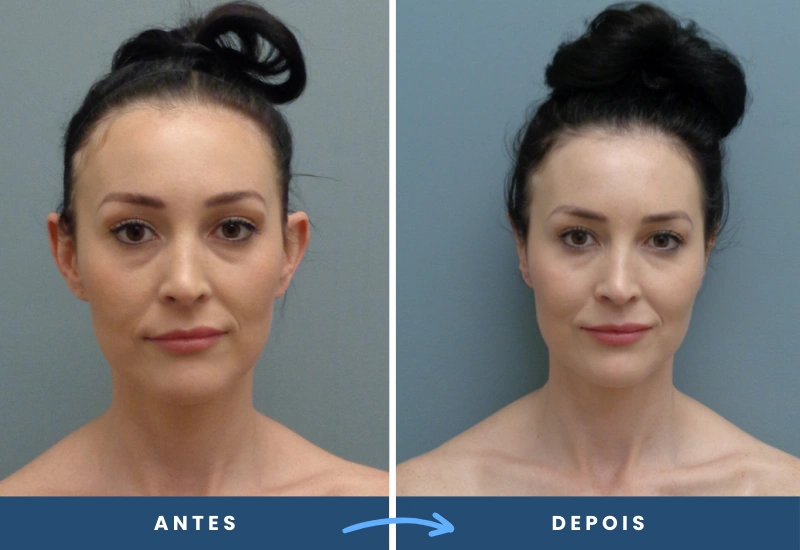 Antes e depois de otoplastia em mulher, mostrando orelhas mais alinhadas e proporcionais, realizado em São Bernardo do Campo.