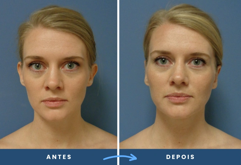 Antes e depois de otoplastia em mulher, com orelhas alinhadas e esteticamente proporcionais, realizado em São Bernardo do Campo. Antes e depois de otoplastia em mulher, com orelhas alinhadas e esteticamente proporcionais, realizado em São Bernardo do Campo.