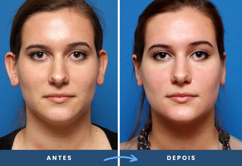 Antes e depois de otoplastia cirurgia da orelha em mulher, cirurgia plástica realizada em São Bernardo do Campo.