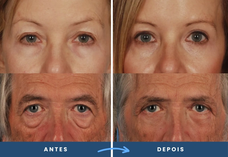 ntes e depois de blefaroplastia em diferentes pacientes, destacando resultados naturais e delicados. ntes e depois de blefaroplastia em diferentes pacientes, destacando resultados naturais e delicados. Cirurgia realizada em são bernardo do campo, pelo cirurgião plástico dr porfirio martinez