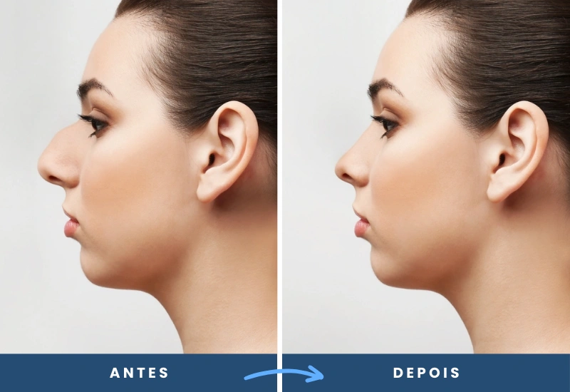 Antes e depois de rinoplastia em mulher, mostrando um nariz mais proporcional e harmônico, realizado em São Bernardo do Campo. Antes e depois de rinoplastia em mulher, mostrando um nariz mais proporcional e harmônico, realizado em São Bernardo do Campo.
