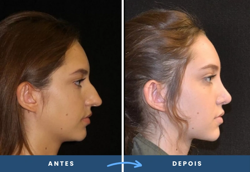 Antes e depois de rinoplastia em mulher, destacando um nariz mais alinhado e esteticamente equilibrado, realizado em São Bernardo do Campo.
