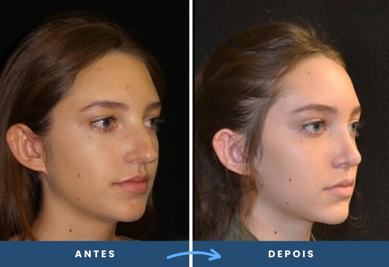 Antes e depois de rinoplastia em mulher, evidenciando contornos mais suaves e proporcionais no nariz, realizado em São Bernardo do Campo. Antes e depois de rinoplastia em mulher, evidenciando contornos mais suaves e proporcionais no nariz, realizado em São Bernardo do Campo.