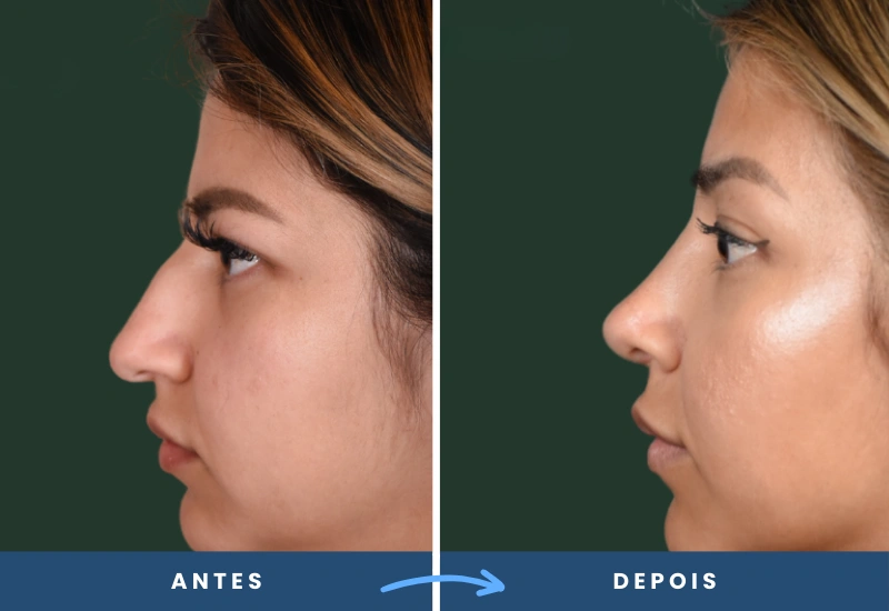 Antes e depois de rinoplastia em mulher, com perfil nasal ajustado e traços equilibrados, realizado em São Bernardo do Campo. Antes e depois de rinoplastia em mulher, com perfil nasal ajustado e traços equilibrados, realizado em São Bernardo do Campo.