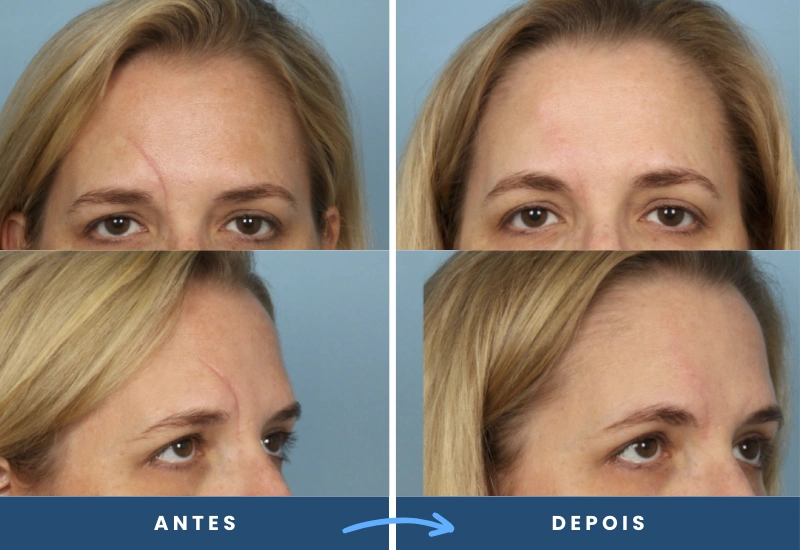 Antes e depois de correção de cicatriz facial na testa de uma mulher, evidenciando redução significativa, realizado por especialista em São Bernardo do Campo.
