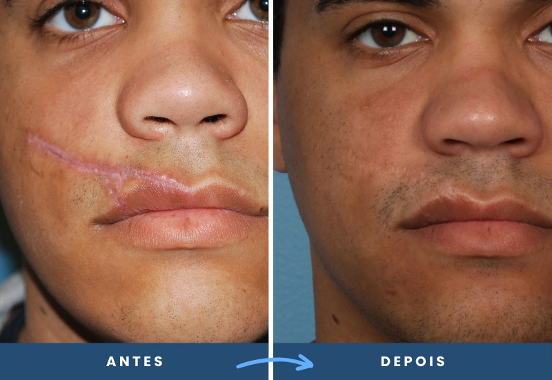 Antes e depois de correção de cicatriz próxima aos lábios, mostrando resultado mais uniforme, realizado em São Bernardo do Campo. Antes e depois de correção de cicatriz próxima aos lábios, mostrando resultado mais uniforme, realizado em São Bernardo do Campo.