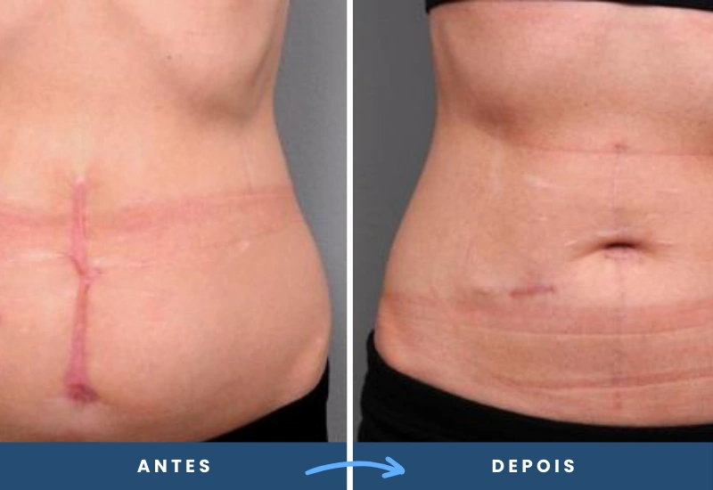 Antes e depois de correção de cicatriz no abdômen, com melhora visível na textura da pele, realizado em São Bernardo do Campo. Antes e depois de correção de cicatriz no abdômen, com melhora visível na textura da pele, realizado em São Bernardo do Campo.