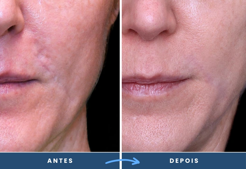 Antes e depois da cirurgia plástica de correção de cicatriz na boca, em São Bernardo do Campo. Antes e depois da cirurgia plástica de correção de cicatriz na boca, em São Bernardo do Campo.