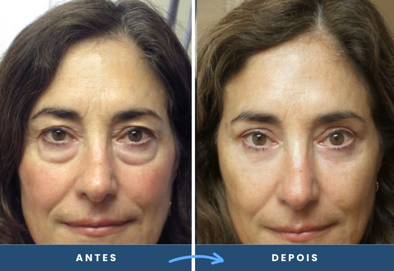 Antes e depois de blefaroplastia em mulher, com pálpebras mais leves e olhar revigorado.
