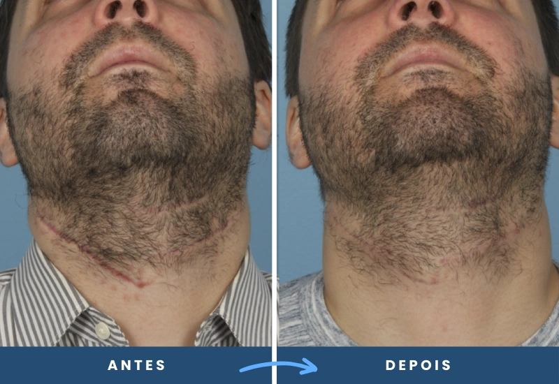 Antes e depois de correção de cicatriz no pescoço em homem, com redução visível das marcas, realizado em São Bernardo do Campo.