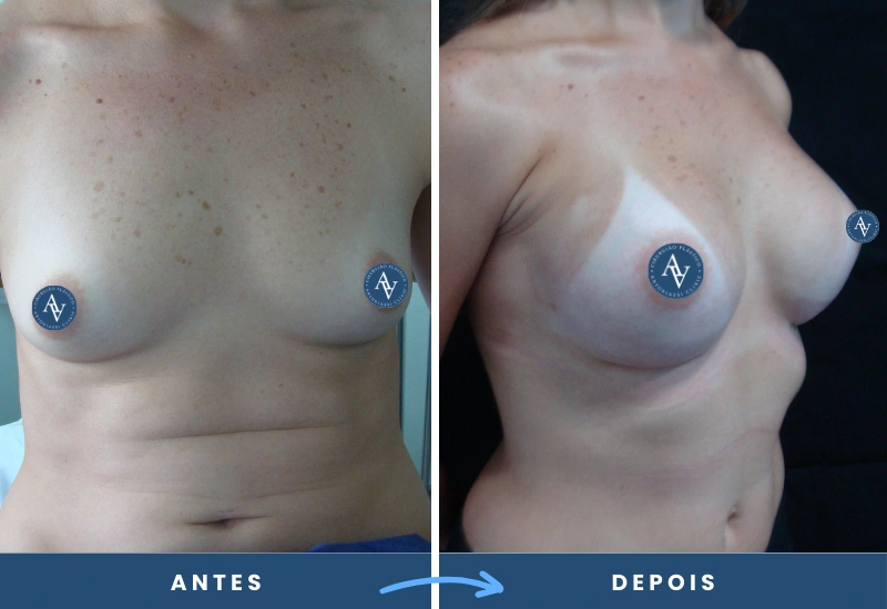 Título destacando o procedimento de mamoplastia de aumento com prótese mamária, realizado em São Bernardo do Campo.