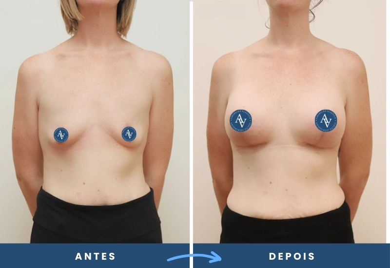 Antes e depois de mamoplastia de aumento em mulher, mostrando mamas com volume equilibrado e natural, realizado em São Bernardo do Campo. Antes e depois de mamoplastia de aumento em mulher, mostrando mamas com volume equilibrado e natural, realizado em São Bernardo do Campo.